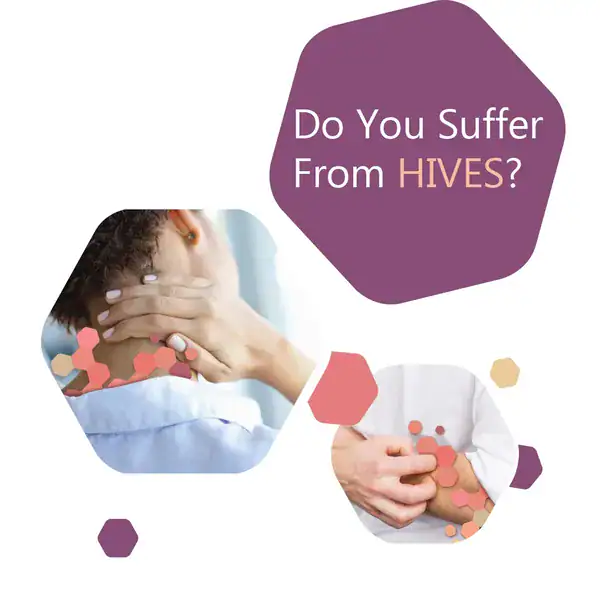 Instagram ad asking Do you suffer from hives, with photos of a hand on a neck and a hand scratching an arm.